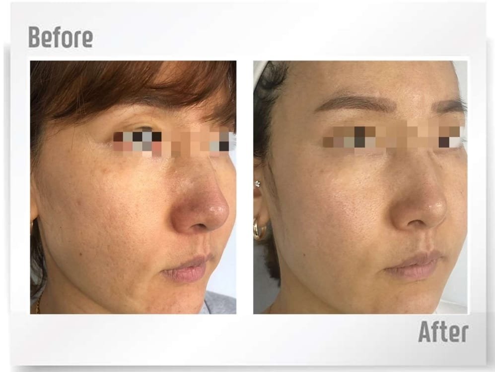 haPN 70 skin tone and brightness before and after