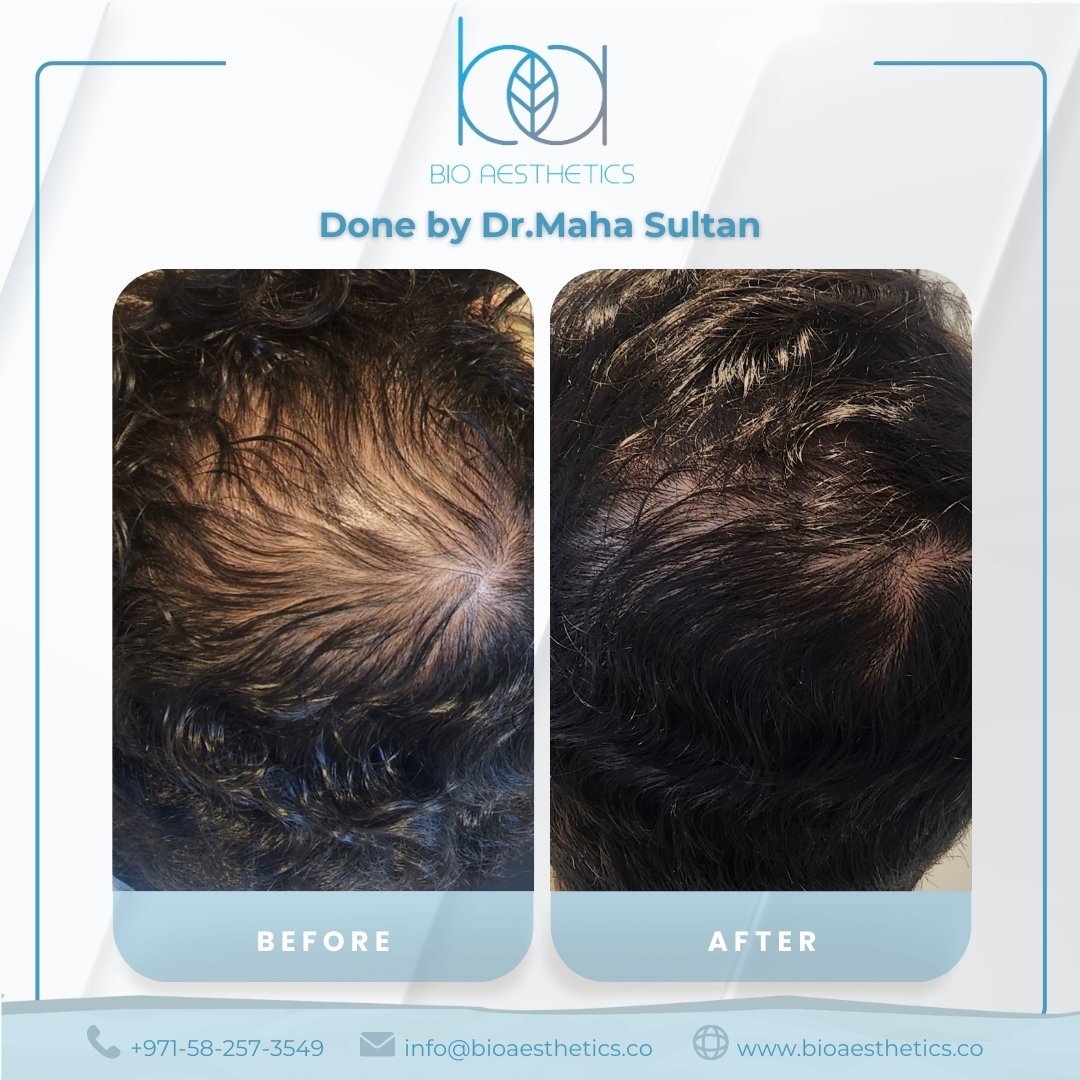 Before and after LIXOFORD-H treatment for hair density