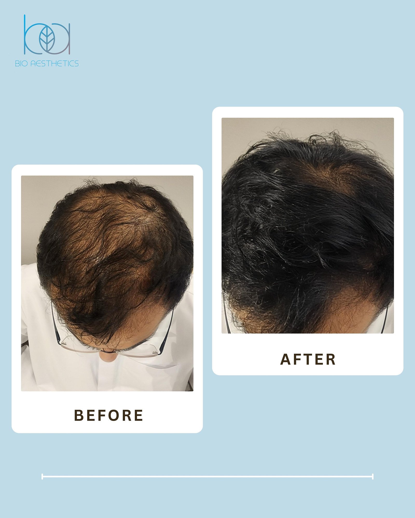 Before and after LIXOFORD-H treatment for hair fall
