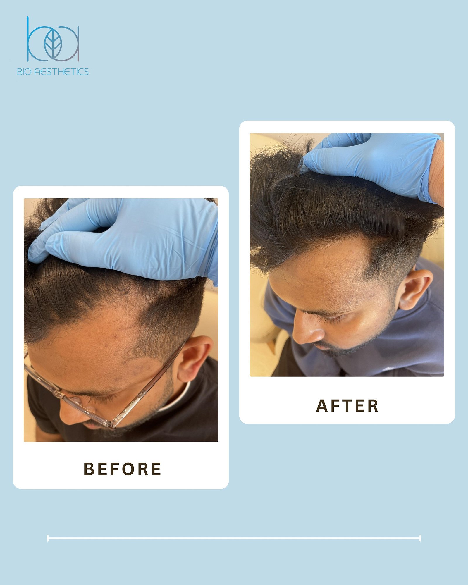 Before and after LIXOFORD-H treatment at the hairline and crown