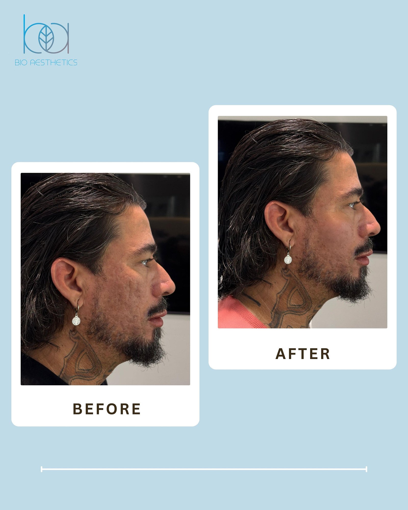 Before and after LIXOFORD-S treatment for overall skin quality