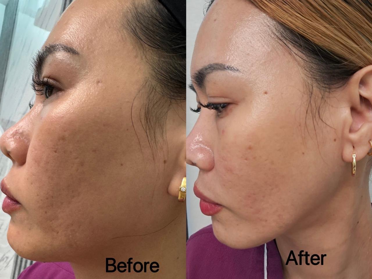 Before and after LIXOFORD-S treatment for skin tone and texture